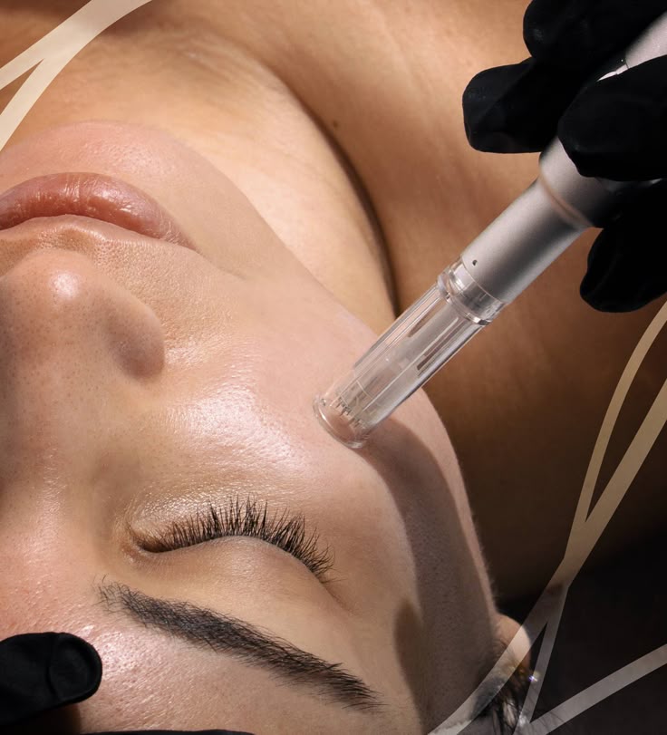 Micro-needling